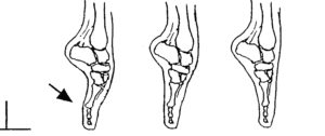 This illustration shows correct bone placement en pointe.